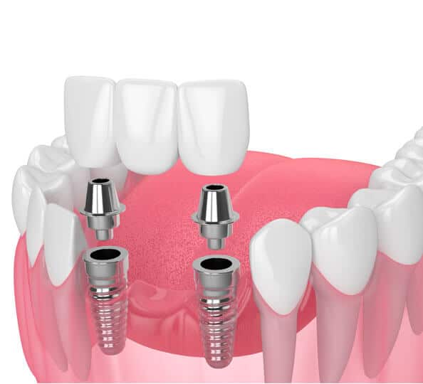 ImplantSupported Dentures Denver PA Cocalico Dental
