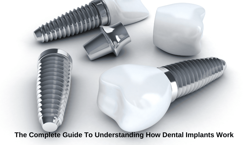 The Complete Guide To Understanding How Dental Implants Work
