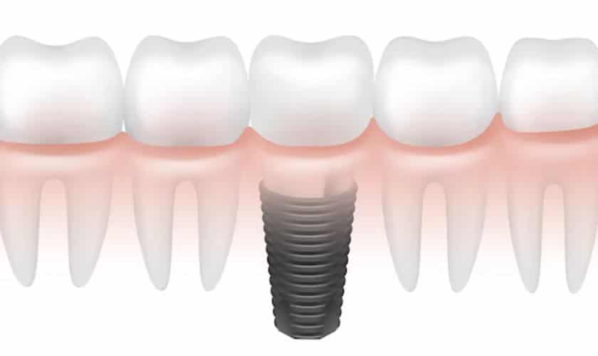 Featured image for “Empower Your Smile: Discovering Dental Implants In Denver”