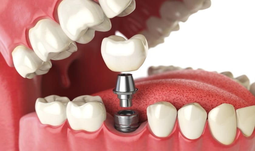 Featured image for “The Step-by-Step Process of Getting Dental Implants Explained”