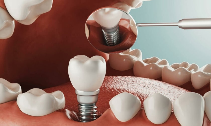Featured image for “Understanding How Dentists Rescue Failed Implants”
