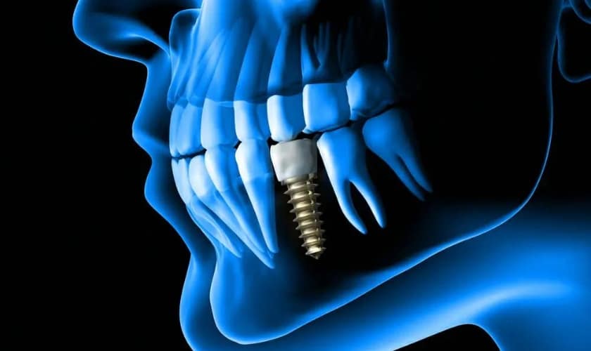 Featured image for “Why Dental Implants Break and How to Safeguard Your Smile”