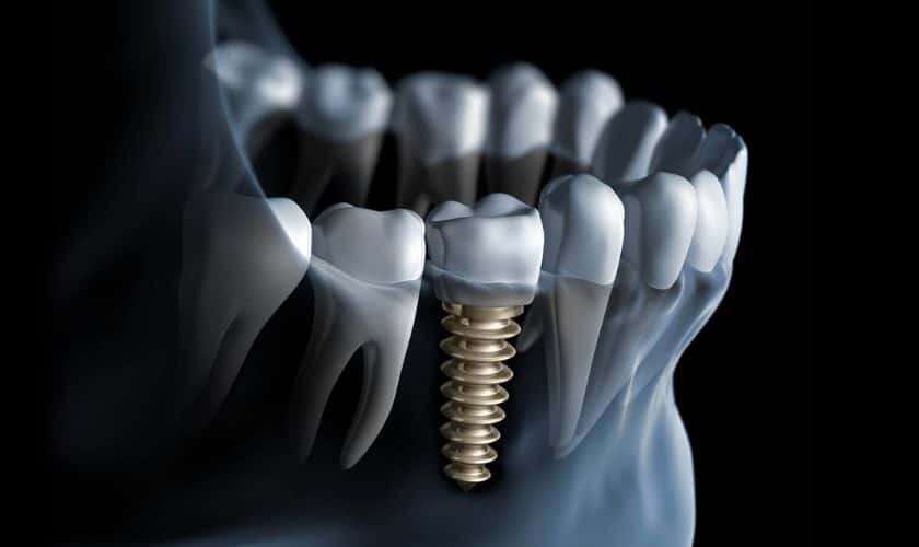 Featured image for “How should I maintain my dental implants?”