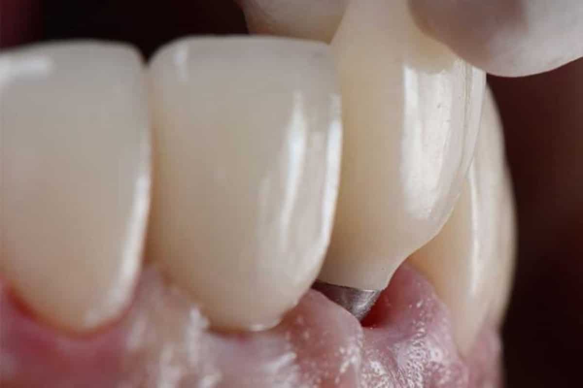 failed-dental-implant-be-repaired