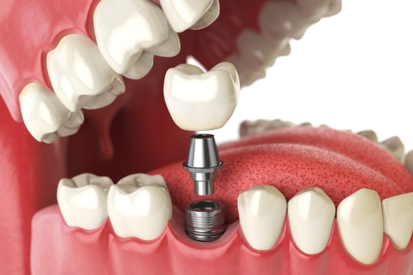 healing process after dental implants what to expect at every stage
