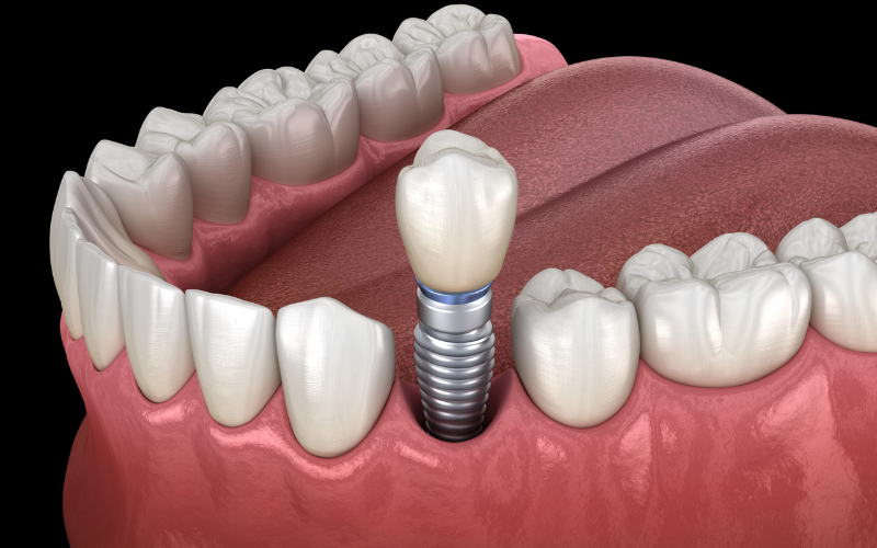 Habits That Damage Your Dental Implants