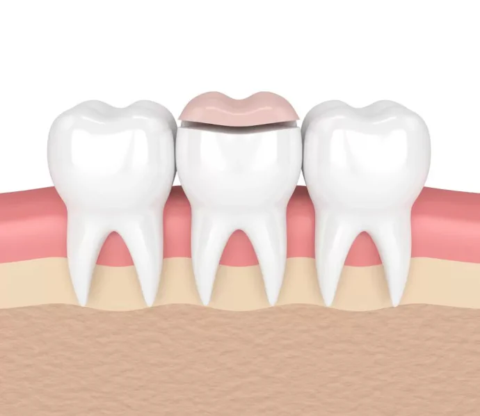 Dental Inlays and Onlays
